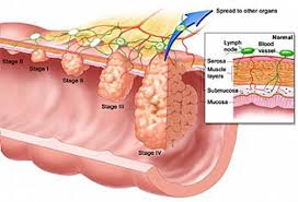 How would it affect me? Understanding Cancer Series P21 Carcinoma In Situ Faculty Of Medicine