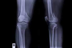 Image result for Knee XRay