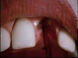 Feinstone escapes his incarceration and heads to the small town of paradise. Dentist 2 The Comparison Bbfc 18 Uncut Movie Censorship Com