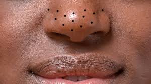 Read my story to see what worked and what changed my life. How To Get Rid Of Blackheads On Your Nose Chin And Forehead Self