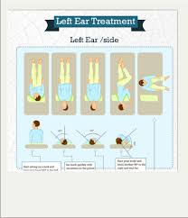 The canalith repositioning procedure for treatment of hunt w.t., zimmermann e.f., hilton m.p. Epley Maneuver What Is It And How To Perform It Epley Maneuver Vertigo Treatment Vertigo Exercises