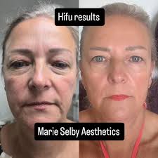 Check out these HIFU results, 8 weeks