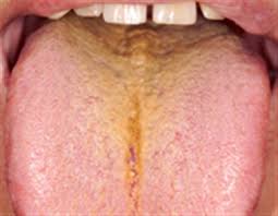 Image result for بیماری زبان جغرافیایی