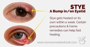 Stye Remedies Eyestyetreatment Eyestyepop Eyestyeteabag Eye Stye Remedies Stye Remedy Skin Care Remedies