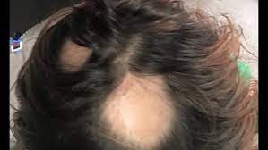 The paul mitchell tea tree products helped me when my hair thinned a lot and i was astonished! Hundreds Of Women Join Class Action Lawsuit Claiming Wen Hair Care Product Caused Hair Loss Wnep Com