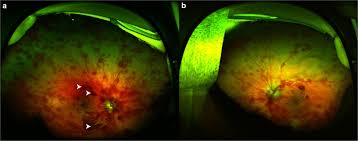 The most frequent cause of an operculated tear is a pvd. Non Contact Ultra Widefield Retinal Imaging Of Infants With Suspected Abusive Head Trauma Eye
