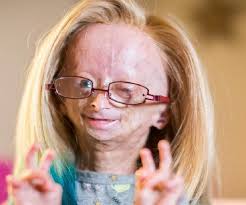 Adalia Rose The Girl With Progeria Facts Her Family Life