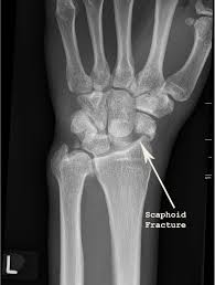 Image result for Fall on Outstretched Hand