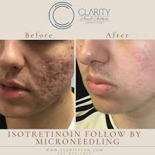 TOP 10 BEST Acne Scar Treatment in Chesapeake, VA