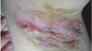 Acne Inversa Fieser Als Pickel An Diesen Stellen Ist Akne Viel Schlimmer Bildplus Inhalt Gesundheit Bild De
