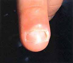 Image result for paronychium