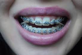 How do you fix a overbite? What Can Rubber Bands Do For My Bite Ismile Orthodontics