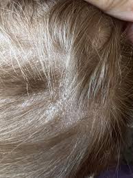 Image result for white scabs on the head in children