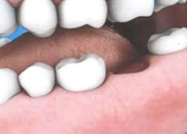 Image result for Dry Socket