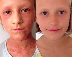 アトピー性皮膚炎を三ヶ月で克服した方法 health and beauty tips body health eczema cure