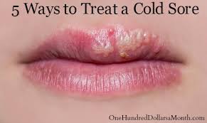 How fast does abreva work? How To Treat A Cold Sore One Hundred Dollars A Month