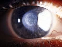 Surface Ablation: Photorefractive Keratectomy, Lasek, Epi-Lasik, And  Epi-Lasek - American Academy Of Ophthalmology
