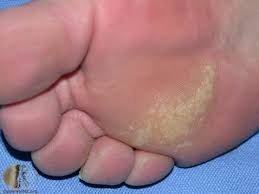 Vorter er små utvekster på hender eller føtter. Vorter Vorter Under Foten Oslo Hudlegesenter