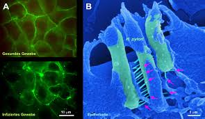 Treatment often involves surgery or radiation therapy. How Helicobacter Pylori Causes Gastric Cancer Faculty Of Sciences