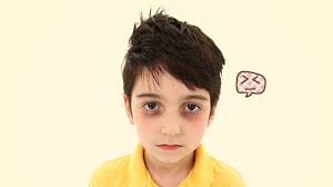 Lingkaran hitam di mata adalah perubahan warna kulit menjadi lebih gelap di bawah mata. Ada Lingkaran Hitam Di Bawah Mata Anak Normalkah Orami