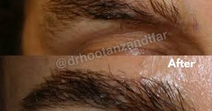 Beeson is a plastic surgeon in indianapolis, indiana and is affiliated with multiple hospitals in the area, including ascension st. Dr Hootan Zandifar Md Plastic Surgeon Otolaryngology Facial Plastic Surgery In Beverly Hills Ca 90211 Findatopdoc Com