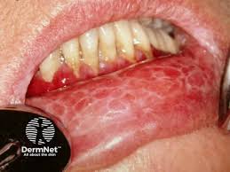 Image result for lichen planus on tongue)