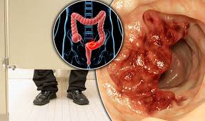 Check spelling or type a new query. Bowel Cancer Symptoms Signs Include Thin Poo What A Healthy Stool Looks Like Express Co Uk