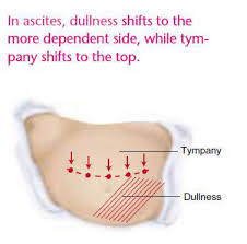 Image result for Shifting Dullness Test