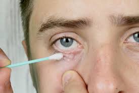 Image result for demodex rosacea