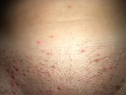 If you pick at an ingrown before the hair is long enough to come out you could cause skin damage. I M At A Loss With My Ingrown Hairs I M A Frequent Waxer And Use An Ingrown Hair Product Everyday Help Popping
