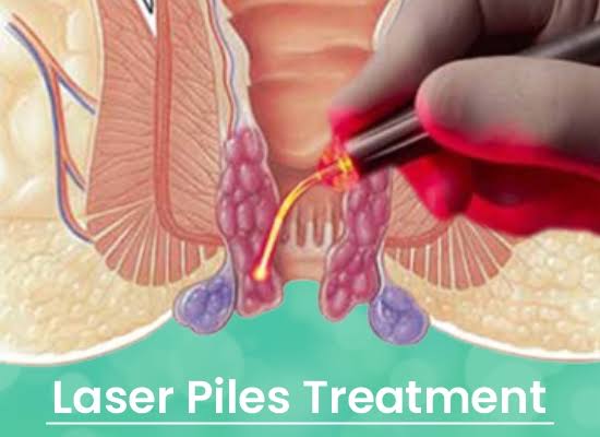 Laser Piles Treatment in Shikrapur, Maharashtra product image
