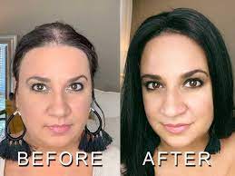 Non Surgical Hair Replacement It Never Fails Unless