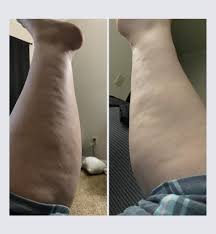 Image result for Lipodystrophy
