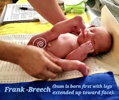 Image result for Breech Delivery