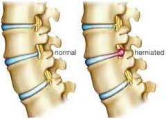Most people recover from a slipped disk within six. Low Cost Herniated Disc Surgery In India Affordable Herniated Disc Surgery
