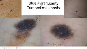 Image result for Blue Nevus