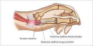 The entire process can be very stressful. Wrist Tendon Anatomy Anatomy Drawing Diagram