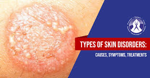 Image result for scabies symptoms
