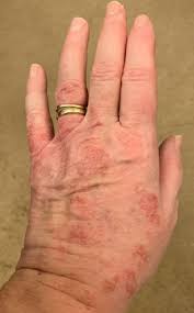 Image result for Photodermatitis