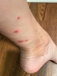 Home Remedies For Fire Ant Bites That Really Work Convos With Karen