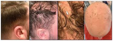 If you notice any other effects, check with your healthcare professional. Massive Acute Alopecia Of The Scalp In A Patient Treated With Dupilumab Html Acta Dermato Venereologica