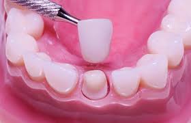 Dental Crowns Archives - Watertown Dental Blog - MN