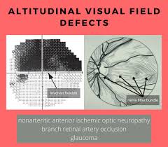 Image result for Visual Field Deficit