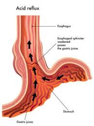 Heartburn occurs when stomach acid comes into contact with the lining of the esophagus. Heartburn And Acid Reflux After Lap Band Surgery With No Weight Loss Bariatric Surgery Source