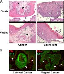 Gemini and cancer should run a mile from each other! gemini and cancer compatibility score: Prevention And Treatment Of Cervical Cancer In Mice Using Estrogen Receptor Antagonists Pnas