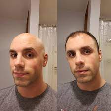 How would i look bald reddit. I Decided Bald Is Greater Than Balding Bald