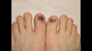 When nails grow long, they often catch on surfaces such as carpet, for instance. New Toenail Growth Process 11 Months In 10 Seconds No Audio Youtube