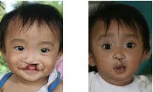 Transforming Faces Transforming Children's Lives