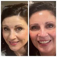 Confidence and glow at 43 without botox or fillers