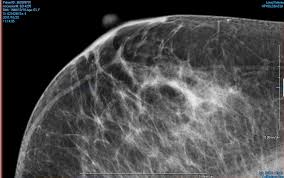 If you're younger than 25. Women With Dense Breasts Will Have To Look Beyond Ultrasound For Useful Supplemental Breast Cancer Screening Imaging Technology News